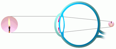 Hipermetropia